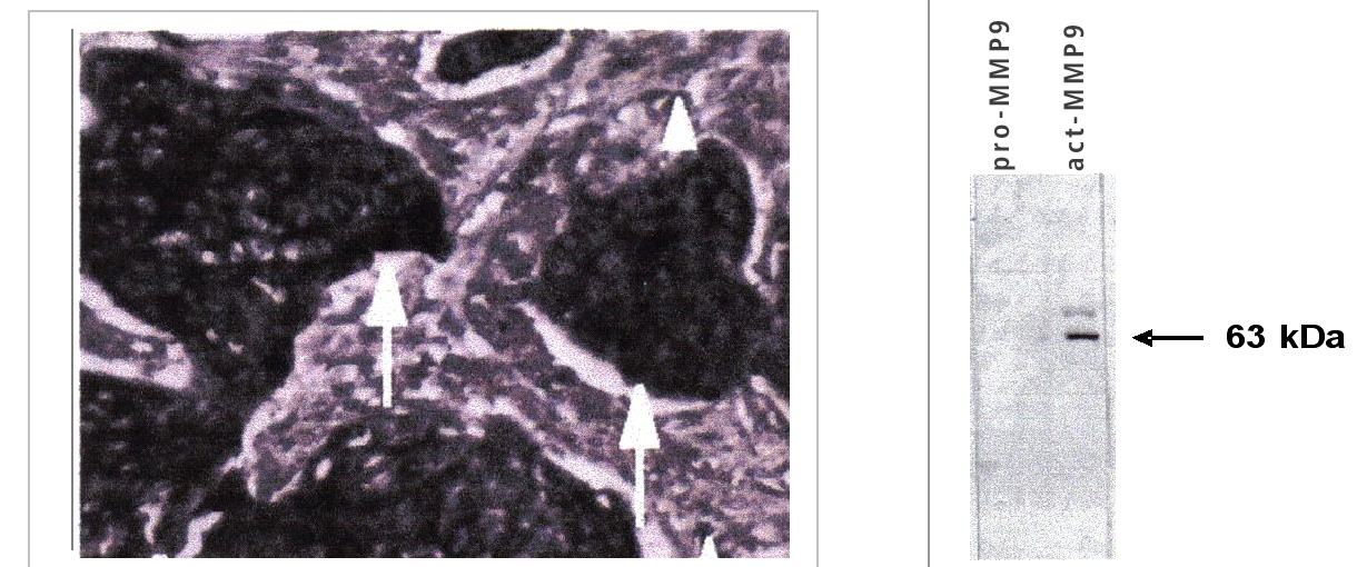 "Left:  Immunohistochemical staining of paraffin embedded esophageal tumors using Act-MMP9 antibody (Cat. No. X2057M).
Right: Western blot using MMP9 antibody on recombinant human proenzyme MMP9 (left lane) and activated enzyme (right lane)."